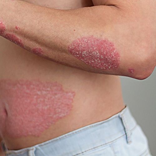 What Is Psoriasis?