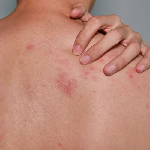 Ouch! Shingles Is on the Rise