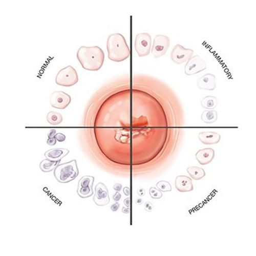 Abnormal Pap Smears 'Normal' in Young Women