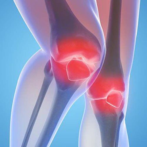 Drug Combo for Arthritis May Replace Bextra And Vioxx