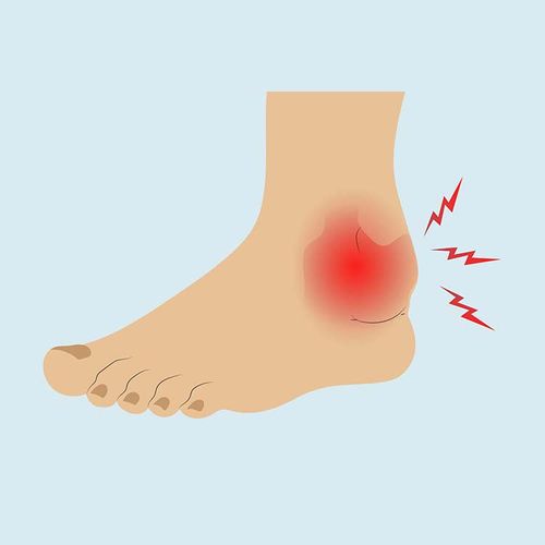 How Simple Sprains Can Lead to Arthritis