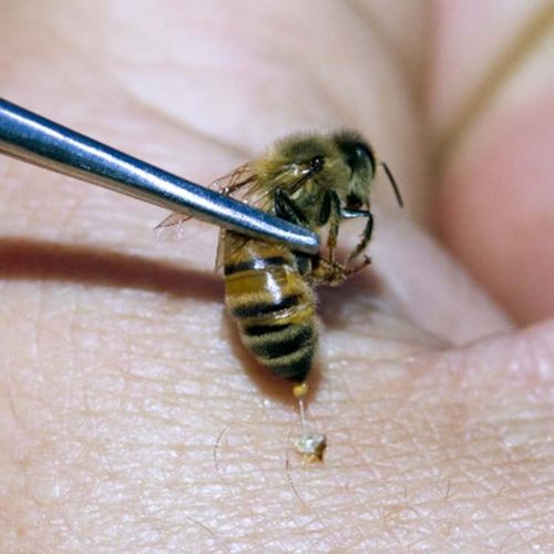 Could a Bee Sting Stop Arthritis Pain?