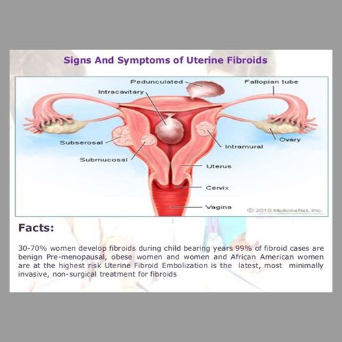 Nonsurgical Technique Shrinks Fibroids