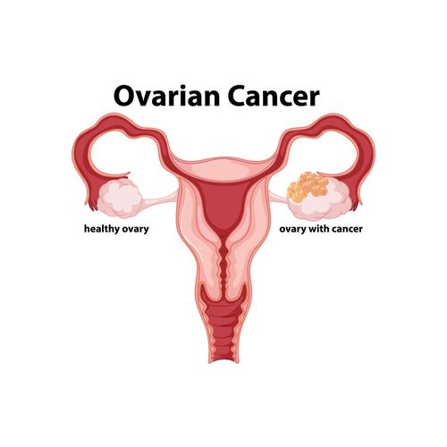 Ovarian Cancer Test Pushes New Technology