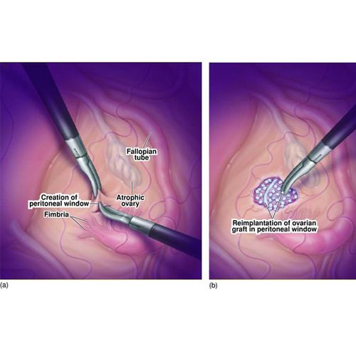 Experimental Ovary Transplant a Success