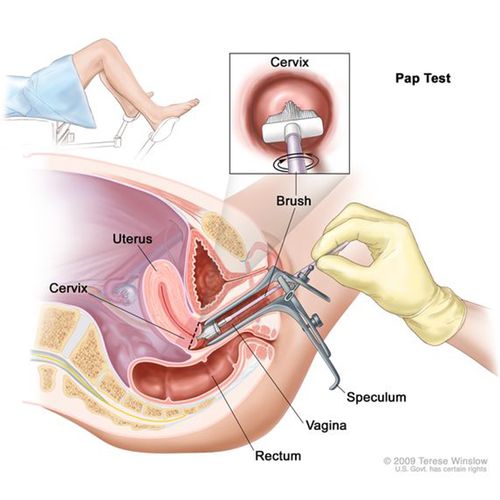 Why Women Are Not Getting Lifesaving Pap Test