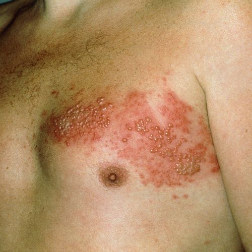 Why It's So Important to Prevent Shingles Now