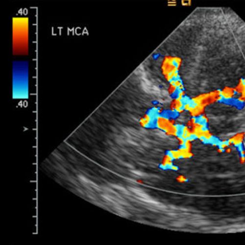 Nurse Finds Ultrasound Limits Stroke Damage