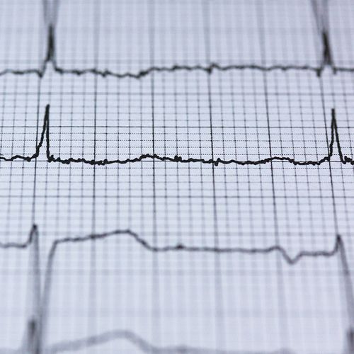 Cutting-Edge Cure for Irregular Heartbeat